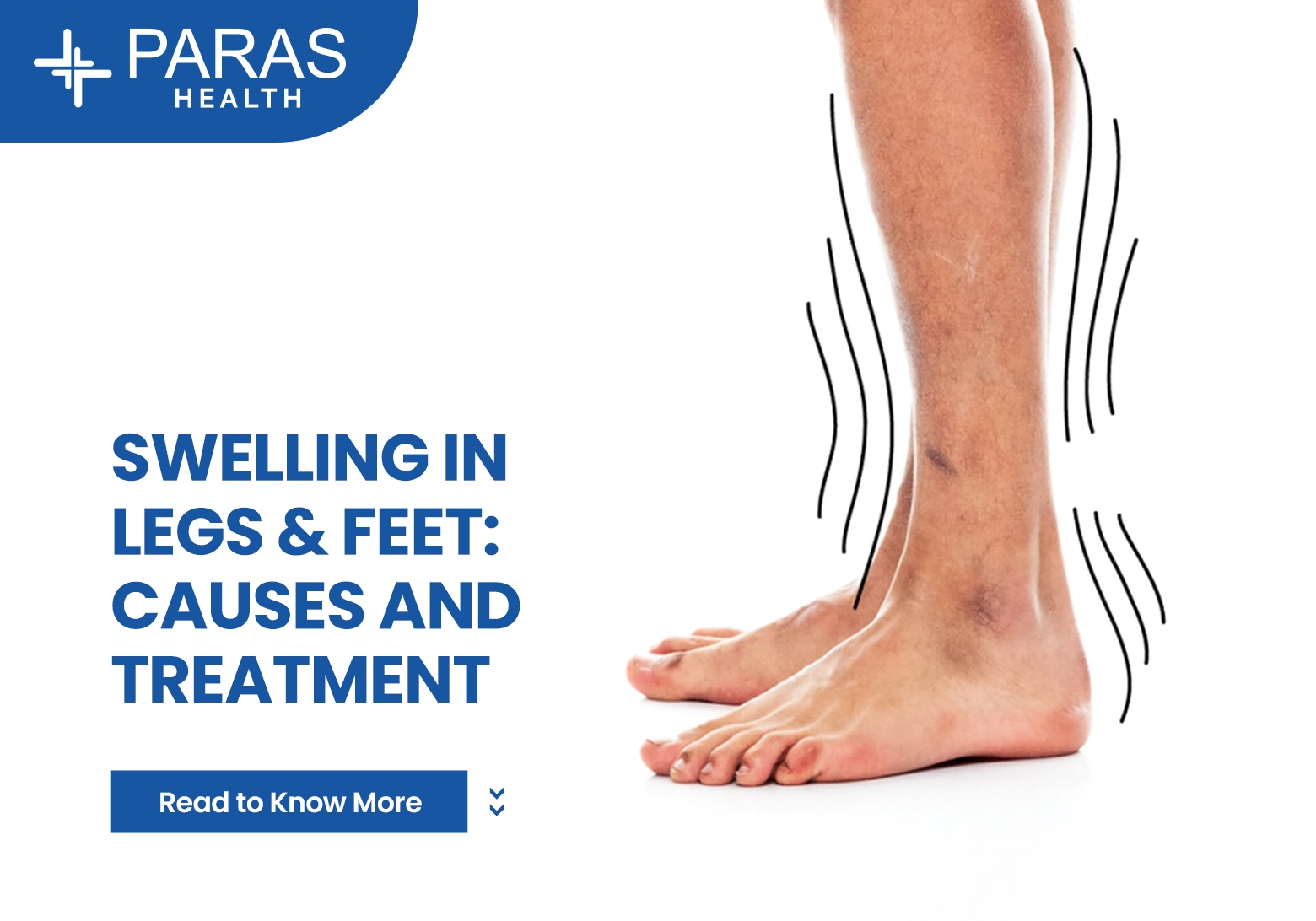 Swelling in Legs & Feet: Causes and Treatment